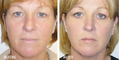 Vampire Facelift Renew Aesthetic Clinic 