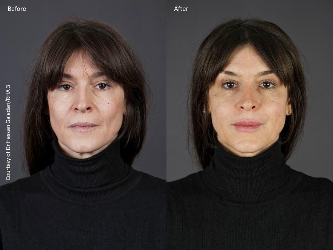 Before and After Dermal Fillers