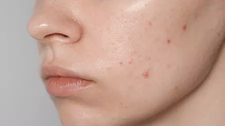 Treatment Renew Aesthetic Clinic