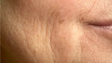 Treatment Renew Aesthetic Clinic