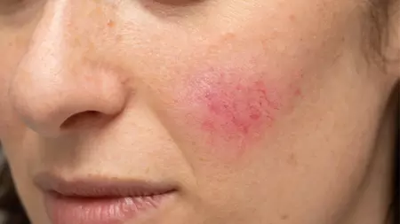 Treatment Renew Aesthetic Clinic