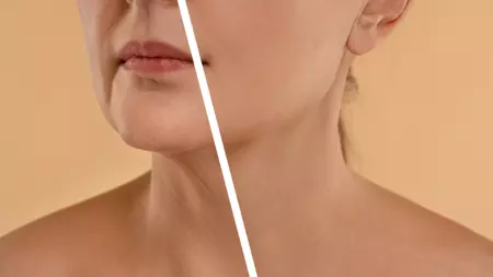Treatment Renew Aesthetic Clinic