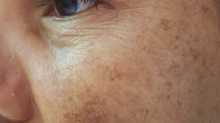 Treatment Renew Aesthetic Clinic