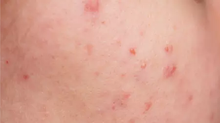 Treatment Renew Aesthetic Clinic