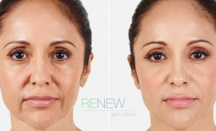 Dermal Fillers – Get Plumped Skin with Fewer Lines in Just 20 Minutes