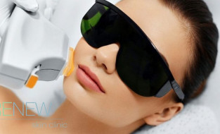 5 Reasons to Choose IPL Photo Rejuvenation at Renew Skin Clinic