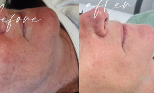 😲Before and after of our client being treated with our new IPL Stellar M22 machine..