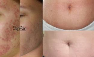 SkinPen Elite now available in our Dublin, Naas & Drogheda clinics