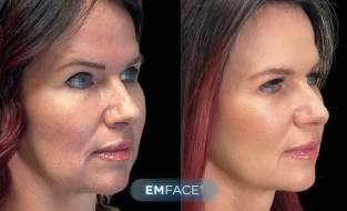 Emface has quickly become one of the most sought-after treatments for patients looking for natural facial rejuvenation.