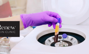 PRP Facial Rejuvenation
