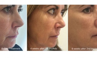 Renew is delighted to announce the arrival of Profhilo, an outstanding, award winning skin remodeling product.