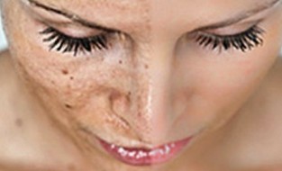 9 Things You Need To Know About Melasma