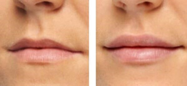 Lip Filler Treatment Image Renew Skin Clinic 