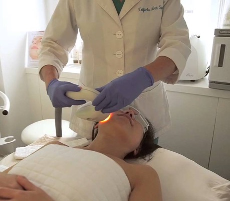 IPL Stellar M22 Treatment Renew Aesthetic Clinic